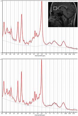 Lower In vivo Myo-Inositol in the Anterior Cingulate Cortex Correlates with Delayed Melatonin Rhythms in Young Persons with Depression